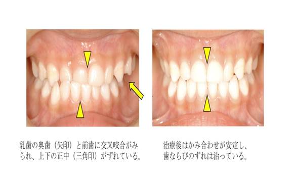 不正咬合の矯正治療 反対咬合(はんたいこうごう)｜小児矯正｜年齢別治療の特徴｜井筒